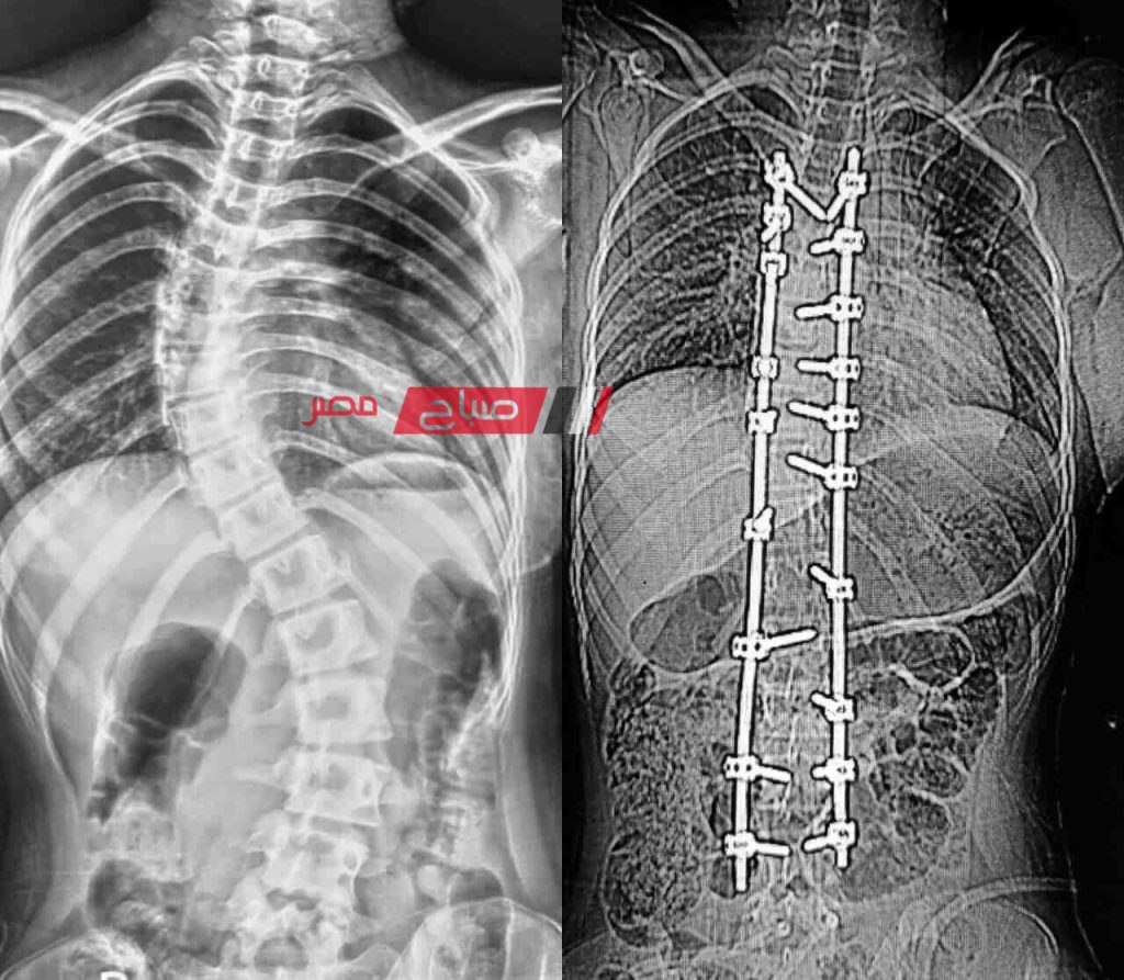 اصلاح اعوجاج العمود الفقري